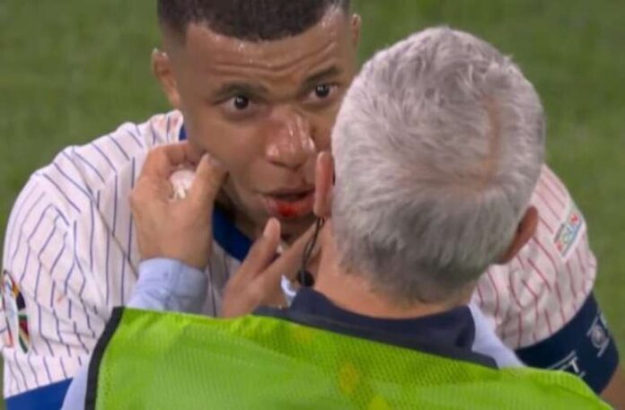 Mbappé Fratura Nariz e Avalia Cirurgia