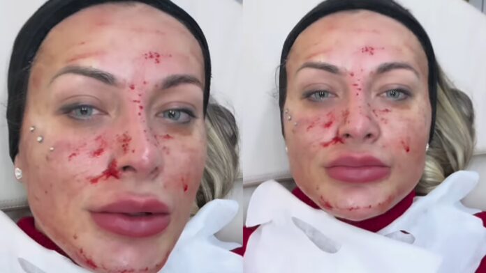 Andressa Urach faz micro-agulhamento