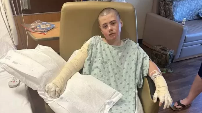 Garoto de 12 anos se queima em trend viral